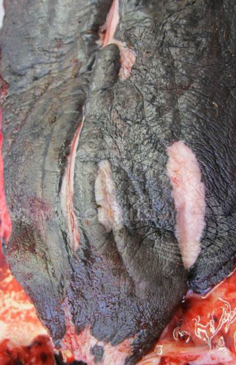 Blekrosa vävnad utan pigment bland vävnad med gråbrunt pigment visar på ärr efter infektion.