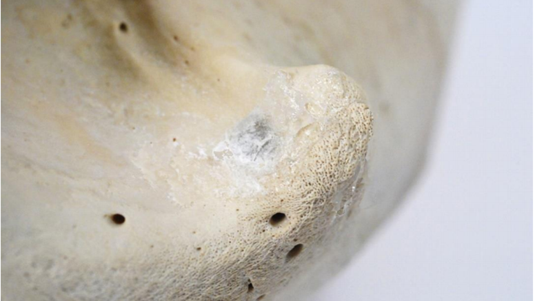 Närbild på kranium med ett antal hål varav ett har en tunn limhinna över sig