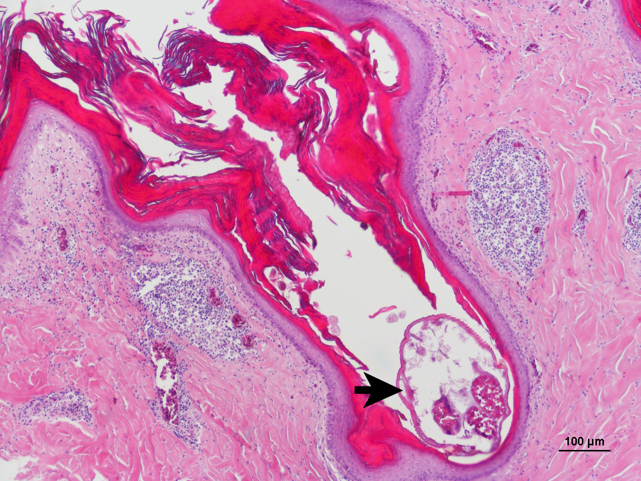 Bild från mikroskop på kvalsterangripen hud hos en tamhöna. Kvalstret (se pil) lever och förökar sig i huden och orsakar inflammation.