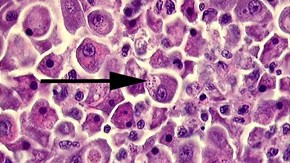 Förändringar i levern hos lax med piscirickettsios. Leverceller innehållande vakuoler med kockoida P. salmonis-bakterier, HE färgning.